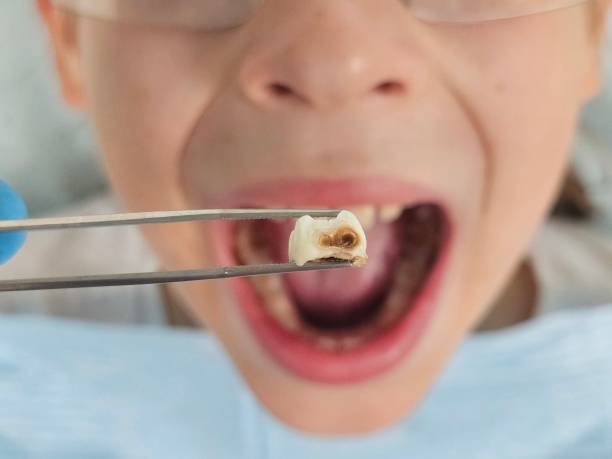 Best Emergency Treatment for Dental Infections or Abscesses in Keokea, HI